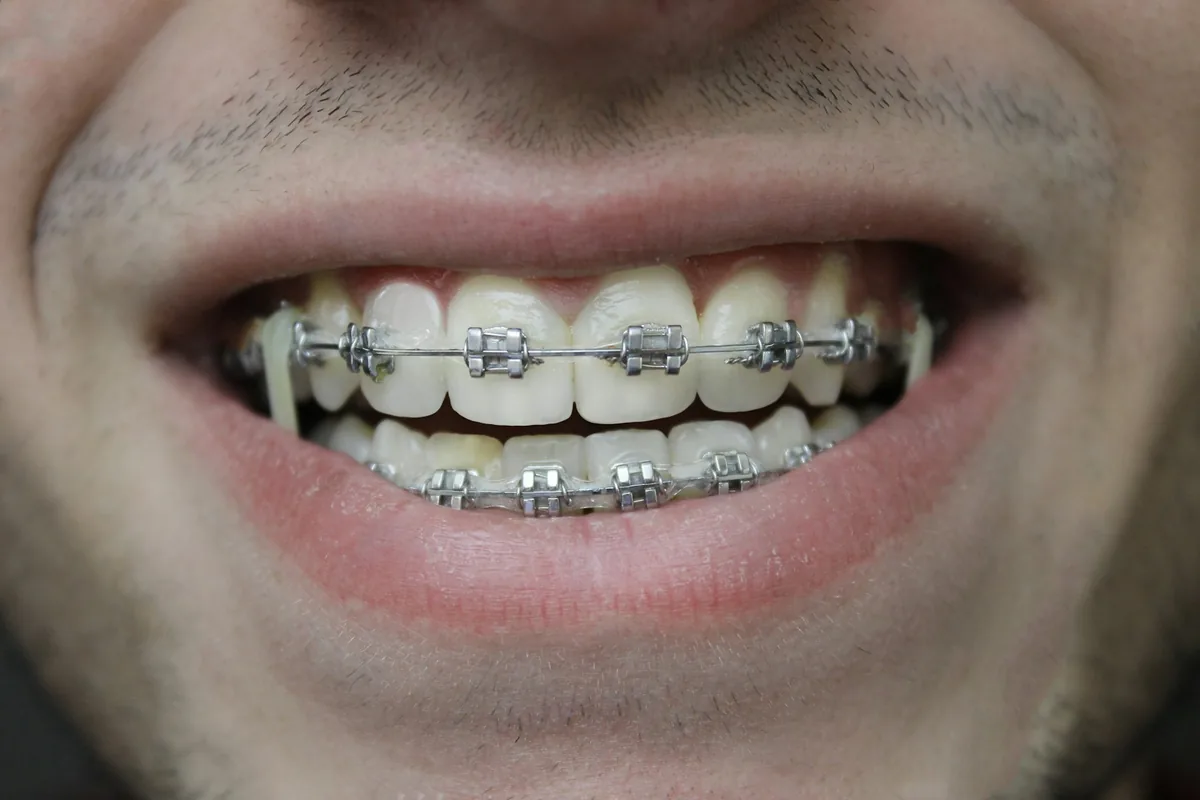 Primer plano de una sonrisa con brackets metálicos