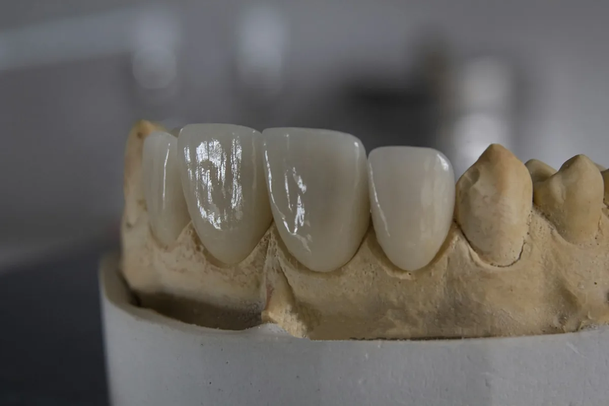 Modelo de prótesis dental sobre yeso